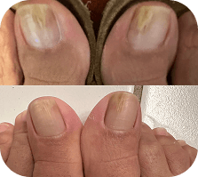 Terry L. toenails before and after