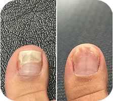 Drew A. nail before and after