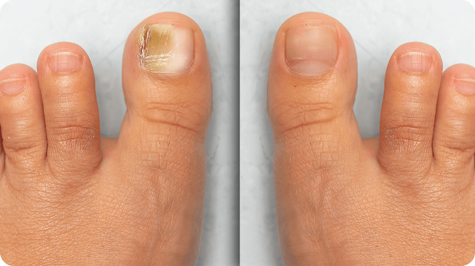 Before and after toenails comparison