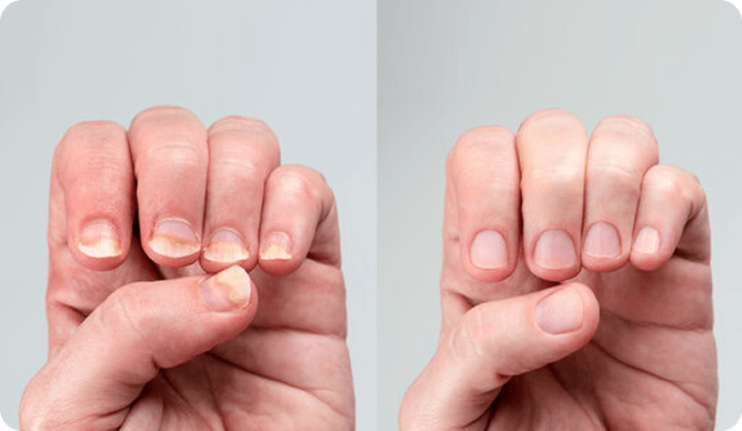 Before and after fingernails comparison